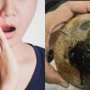 Home remedies for Toothache